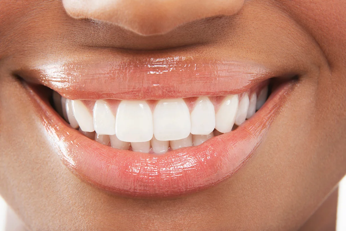 Get a perfect smile with dental veneers