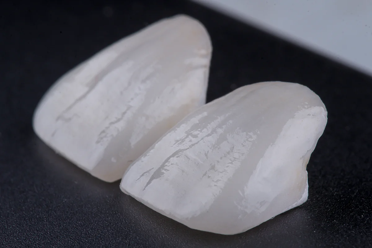 Type of dental veneers