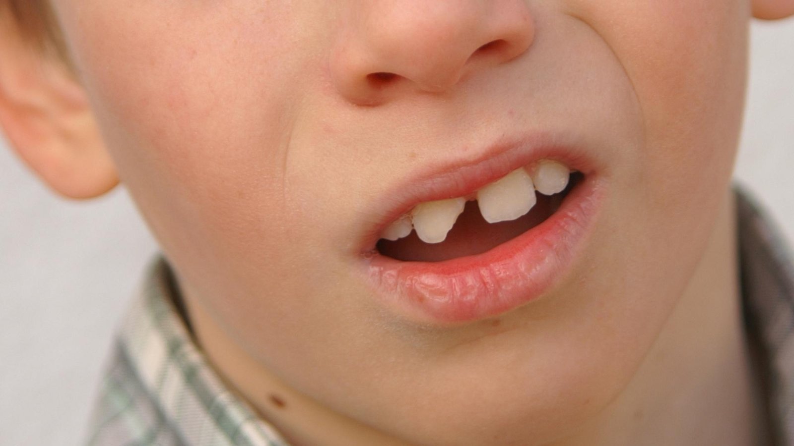 Kid with a broken tooth