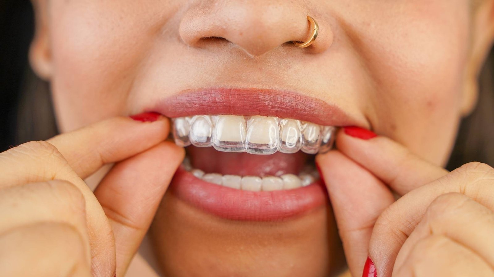 Girl smiling with an Invisalign tray